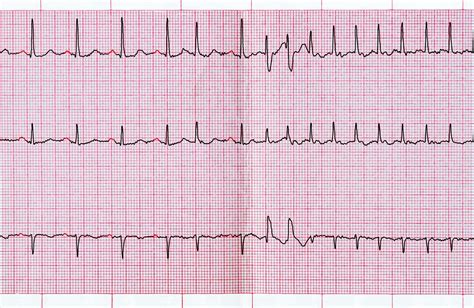 ekg test is hard|abnormal ekg levels.